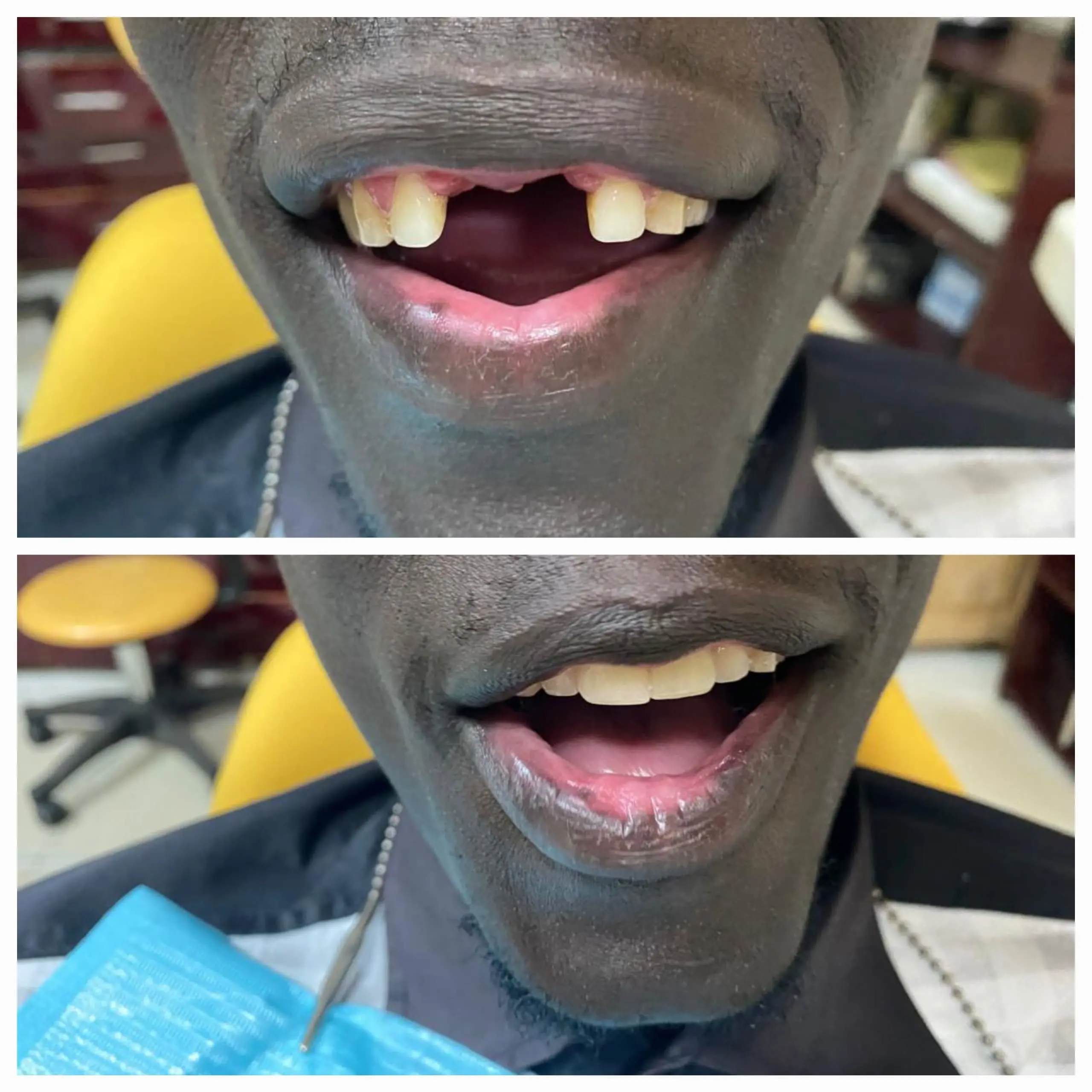 Denture done at Sterling Dental Clinic
